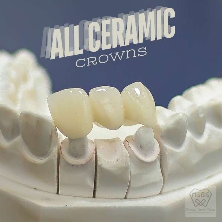 all ceramic crowns