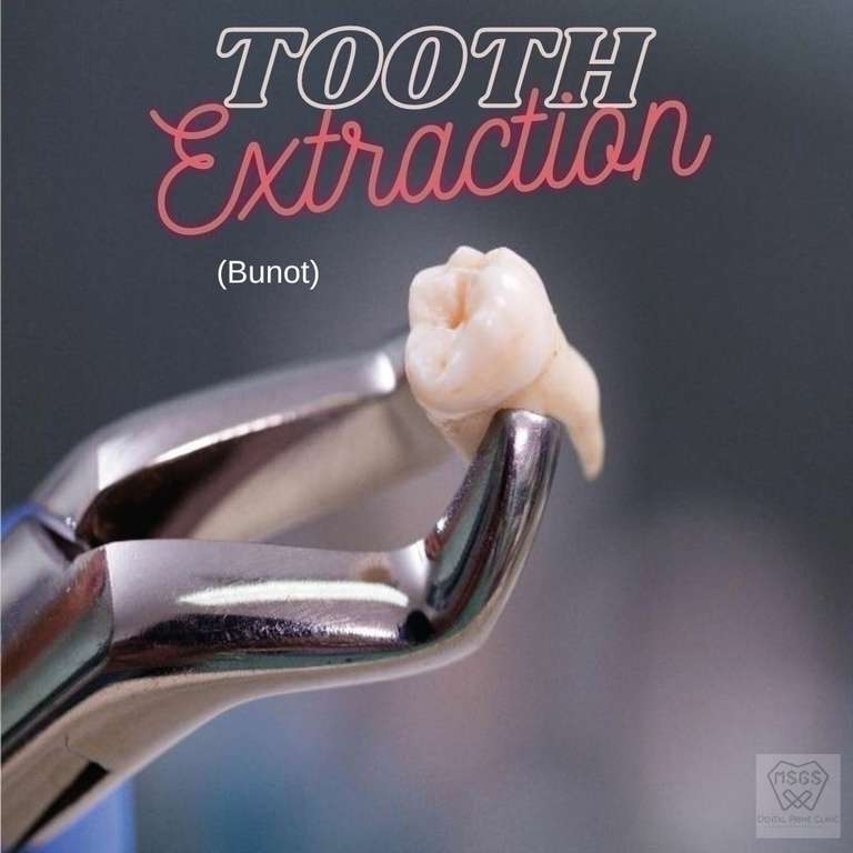 tooth extraction
