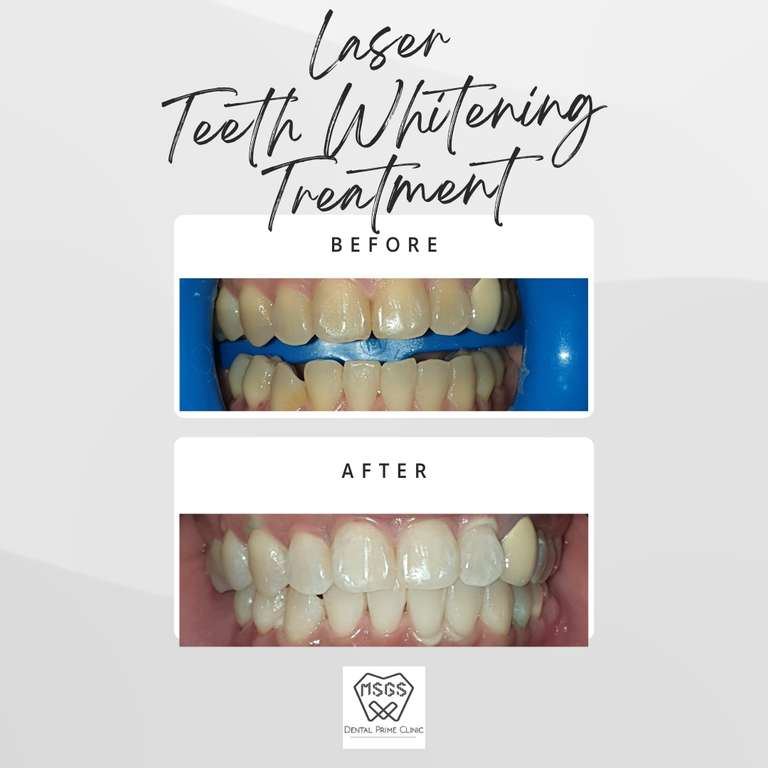 teeth whitening / bleaching