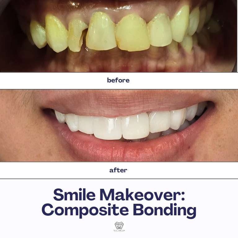 composite bonding / veneers